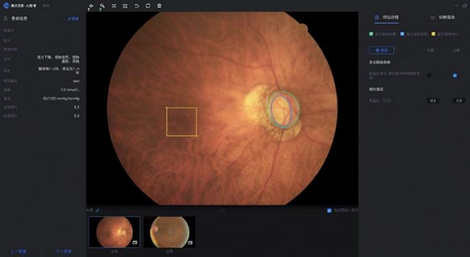AI aids in determining glaucoma, Tencent becomes the first Internet technology company to be approved as an innovative medical device in China